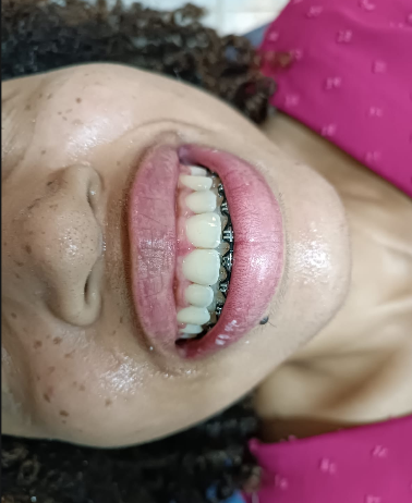 Depois
